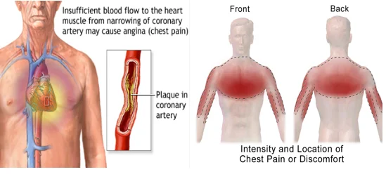 Chest tightness pressure