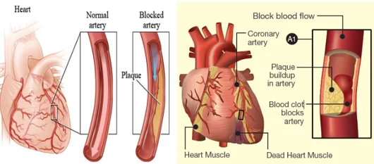 Time is muscle heart attack