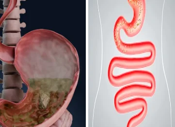 Bloating dairy sensitivity