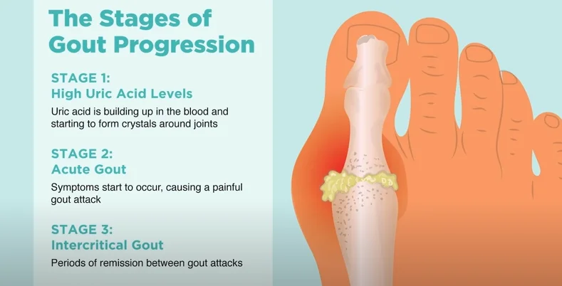 Gout causes diagram