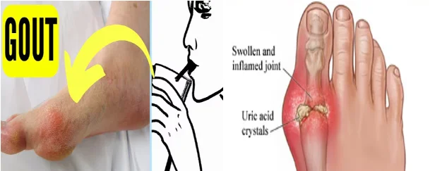 Gout overview illustration