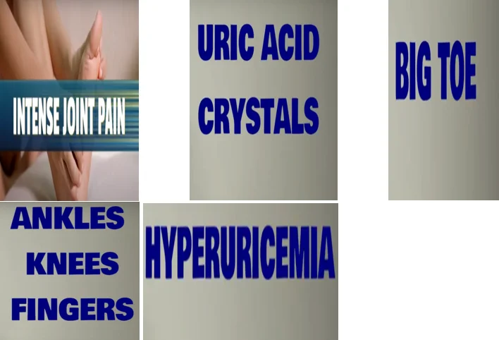 Gout swollen foot symptoms