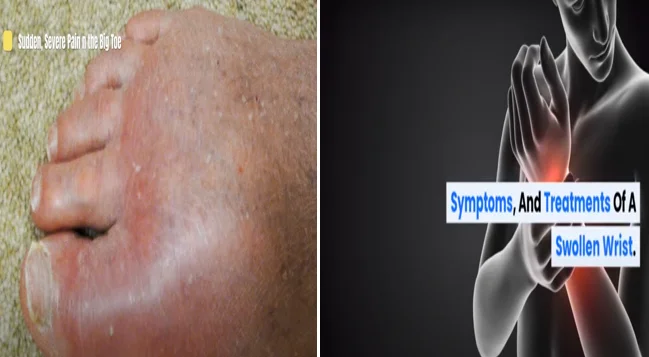 Gout toe and wrist swelling