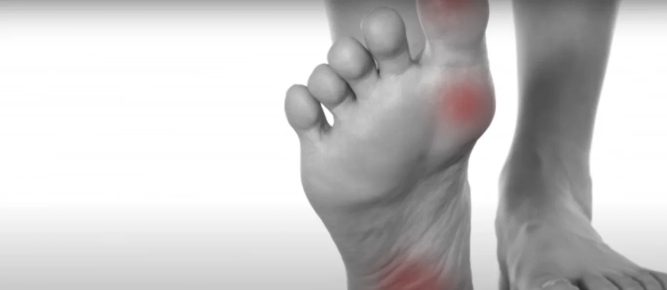 Swollen hands feet gout