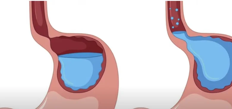 how to fix gut health - illustration 4