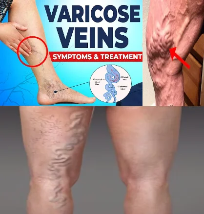 how varicose veins form - illustration 1
