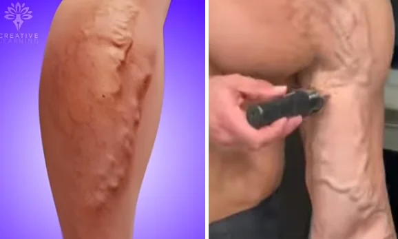 how varicose veins form - illustration 2
