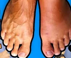 how varicose veins form - illustration 12
