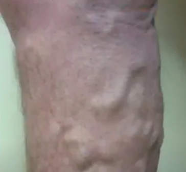 how varicose veins form - illustration 13