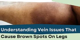 how varicose veins form - illustration 14