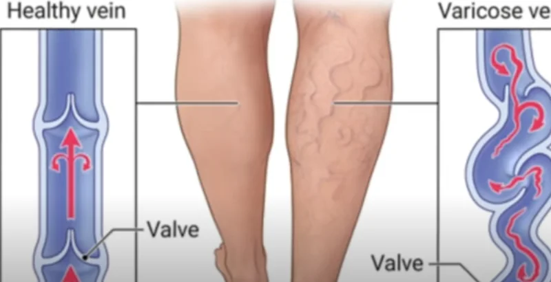 how varicose veins form - illustration 3