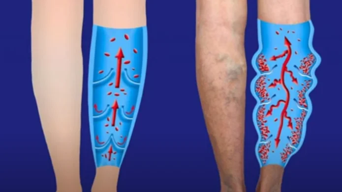 how varicose veins form - illustration 4