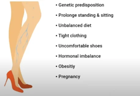 how varicose veins form - illustration 5
