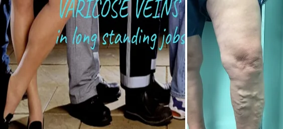 how varicose veins form - illustration 6