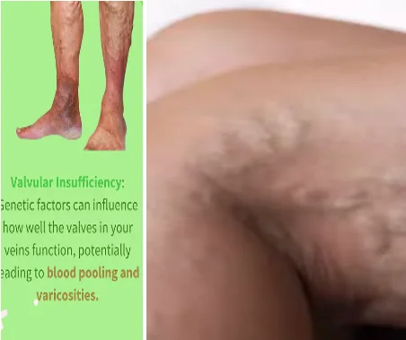 how varicose veins form - illustration 7
