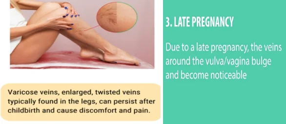 how varicose veins form - illustration 8