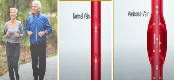 how varicose veins form - illustration 9