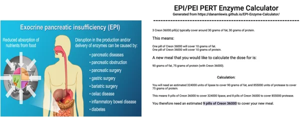 Exocrine pancreatic insufficiency illustration
