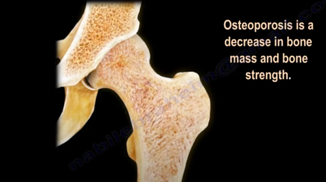 Fracture risk and bone deterioration illustration