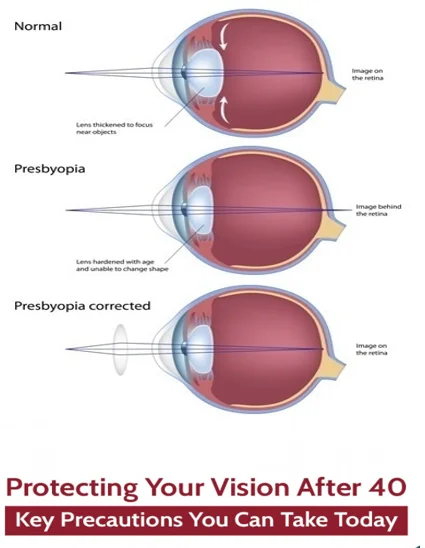 Blurry vision after 40