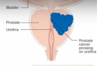 Prostate cancer awareness and early detection for men over 50
