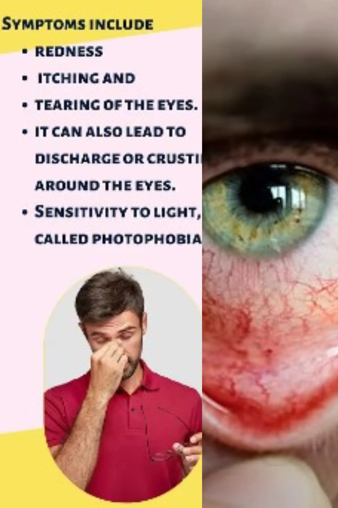 Bulging eyes and Graves disease eye symptoms in hyperthyroidism