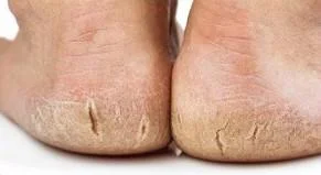 Skin changes and rash symptoms associated with hyperthyroidism and Graves disease