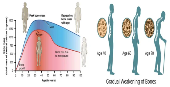 when bones become weak in seniors - illustration 2