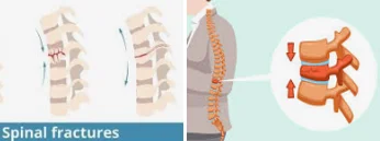 when bones become weak in seniors - illustration 18