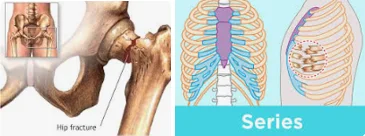 when bones become weak in seniors - illustration 9